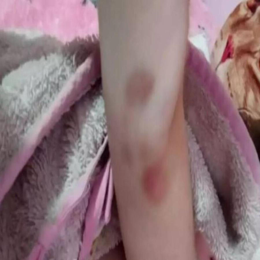 Εξελίξεις στην Πάτρα: Φωτογραφία – ντοκουμέντο από τις μελανιές στο χέρι της 9χρονης Τζωρτζίνας