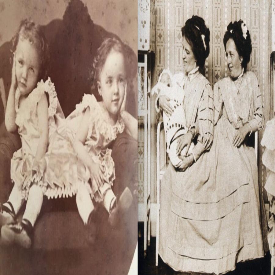 Σιαμαίες δίδυμες: Απίθανη ιστορία των αδερφών Μπλάζεκ που η μία έμεινε έγκυος και χωρίστηκαν μόνο όταν πέθαναν