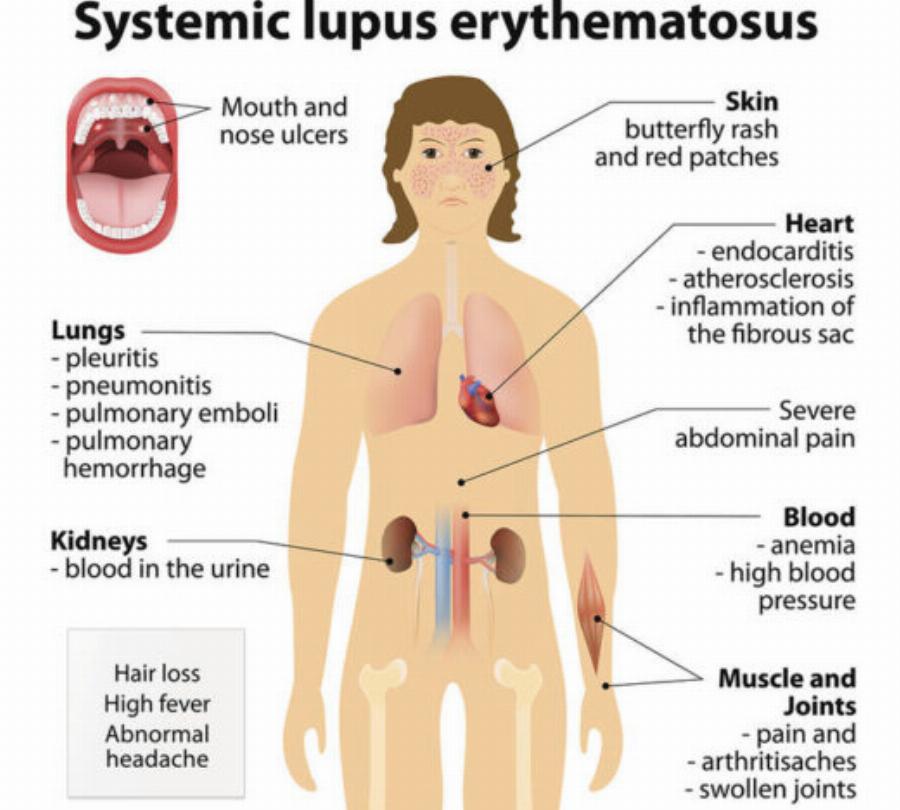 Επτά αυτοάνοσα νοσήματα που εμφανίζονται συχνότερα στις γυναίκες