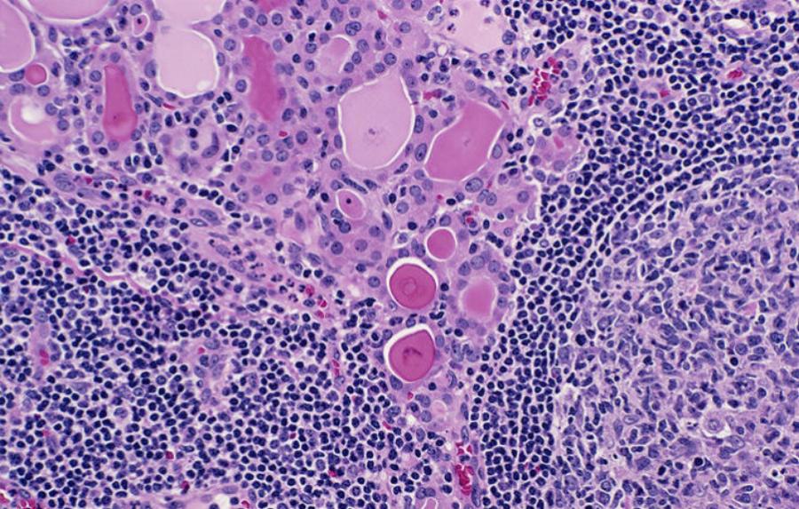 Επτά αυτοάνοσα νοσήματα που εμφανίζονται συχνότερα στις γυναίκες