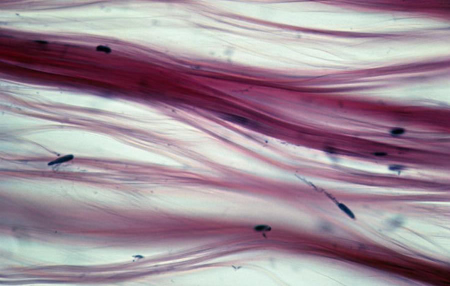 Επτά αυτοάνοσα νοσήματα που εμφανίζονται συχνότερα στις γυναίκες