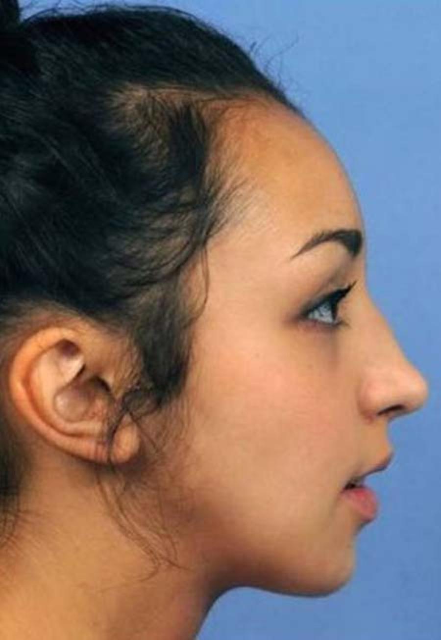 Ellie Jones: Το κορίτσι με το παραμορφωμένο πρόσωπο – Έκανε εγχείρηση και σήμερα την ζηλεύουν