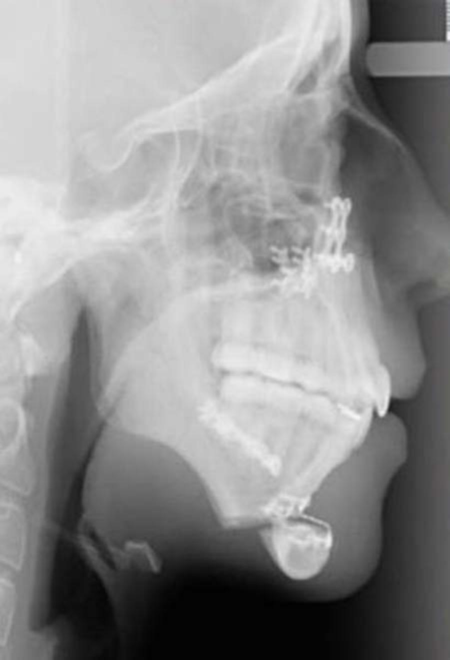 Ellie Jones: Το κορίτσι με το παραμορφωμένο πρόσωπο – Έκανε εγχείρηση και σήμερα την ζηλεύουν