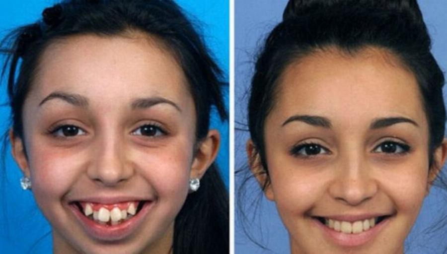 Ellie Jones: Το κορίτσι με το παραμορφωμένο πρόσωπο – Έκανε εγχείρηση και σήμερα την ζηλεύουν