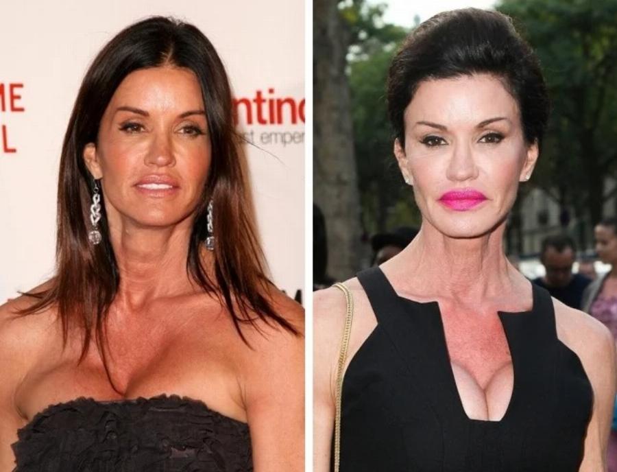 Άλλαξαν ριζικά από τις πλαστικές: 10 περιπτώσεις που καταστράφηκαν από την ματαιοδοξία τους και το νυστέρι