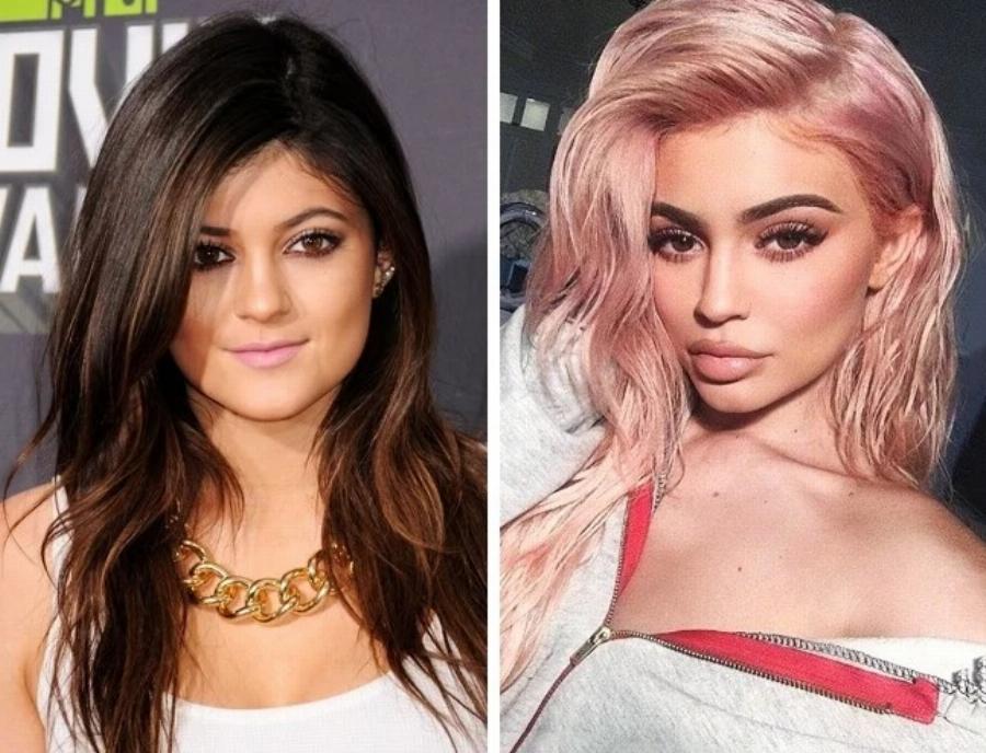 Άλλαξαν ριζικά από τις πλαστικές: 10 περιπτώσεις που καταστράφηκαν από την ματαιοδοξία τους και το νυστέρι