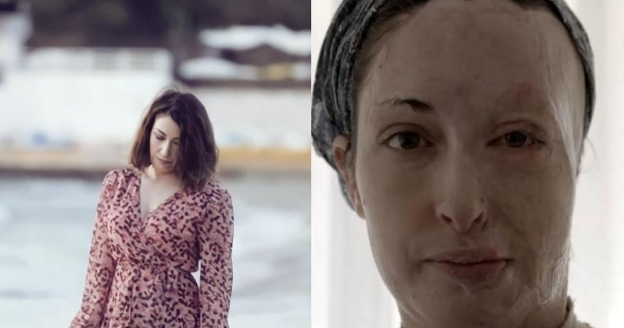 Ιωάννα Παλιοσπύρου: «Το έγκαυμά της ίσως είναι το μεγαλύτερο παγκοσμίως» – Η δήλωση της γιατρού της