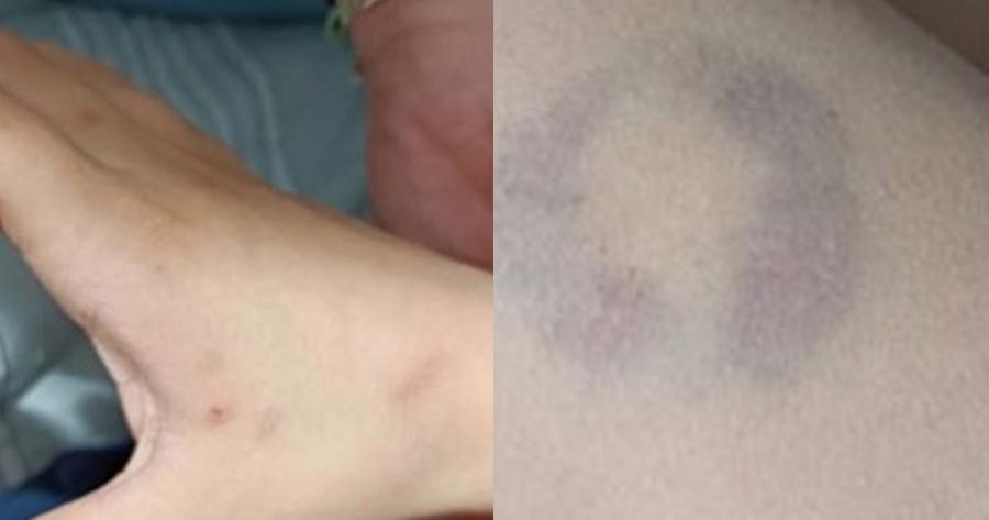 Διευθύντρια σχολείου δάγκωσε 11χρονο μαθητή ΑΜΕΑ – Δήλωσε πως «βρισκόταν σε άμυνα» καθώς της τραβούσε τα μαλλιά