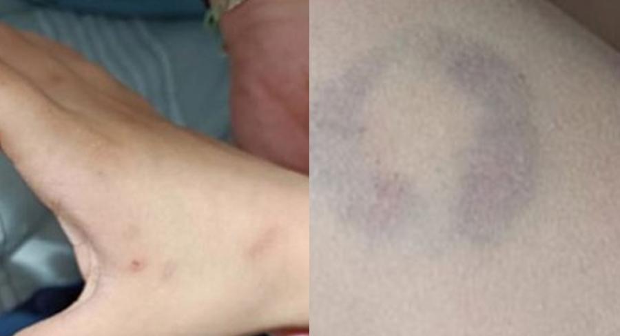 Διευθύντρια σχολείου δάγκωσε 11χρονο μαθητή ΑΜΕΑ – Δήλωσε πως «βρισκόταν σε άμυνα» καθώς της τραβούσε τα μαλλιά