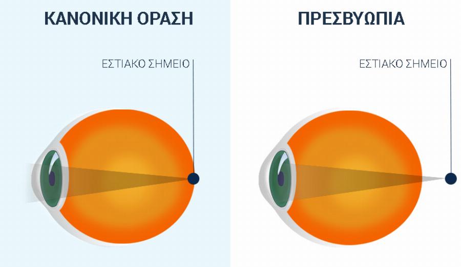 Πρεσβυωπία: Σταγόνες ματιών βάζουν τέλος στα γυαλιά, τους φακούς επαφής ακόμα και στο χειρουργείο