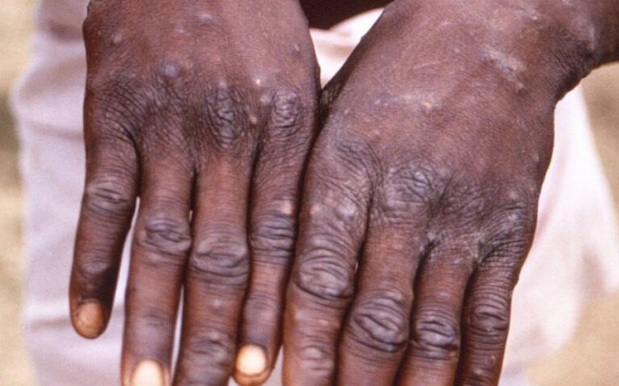 Τι προκαλεί και πώς κολλάει η Ευλογιά των πιθήκων: «Ο ιός θα εξαπλωθεί καλοκαίρι»