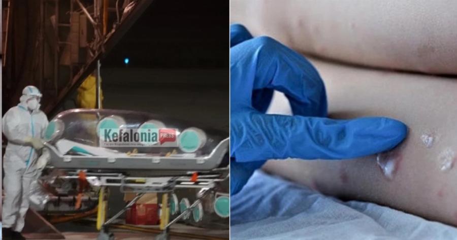 Ξανά μέτρα σε όλο τον κόσμο για την ευλογία των πιθήκων: Αύξηση κρουσμάτων, υποχρεωτική καραντίνα, επιστροφή μάσκας