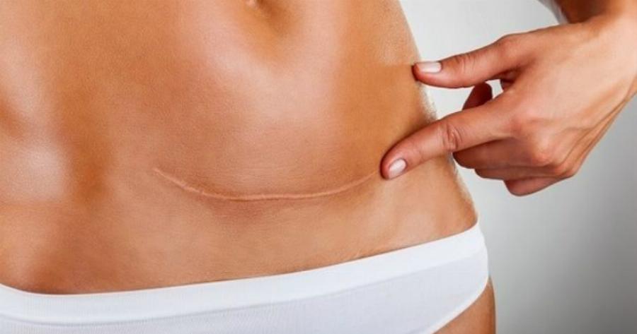 Η αποστομωτική απάντηση μιας μητέρας σε όσους νομίζουν ότι η καισαρική είναι «ο εύκολος τρόπος»