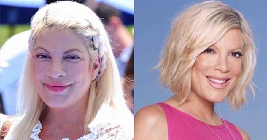 Άλλαξαν ριζικά από τις πλαστικές: 10 περιπτώσεις που καταστράφηκαν από την ματαιοδοξία τους και το νυστέρι