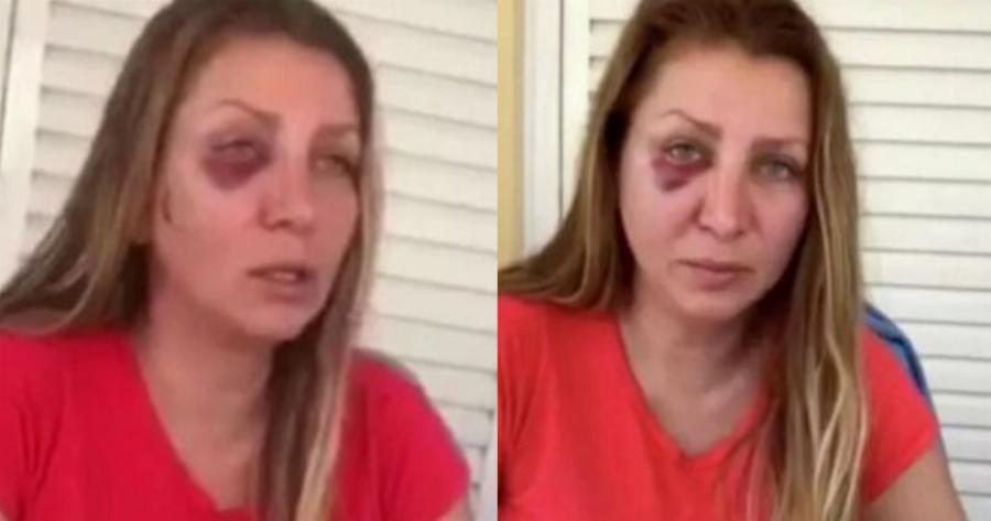 «Φοβόμαστε να μιλήσουμε ρώσικα στον δρόμο» δηλώνει στην κάμερα η Οξάνα που ξυλοκοπήθηκε από Ουκρανούς στην Αθήνα