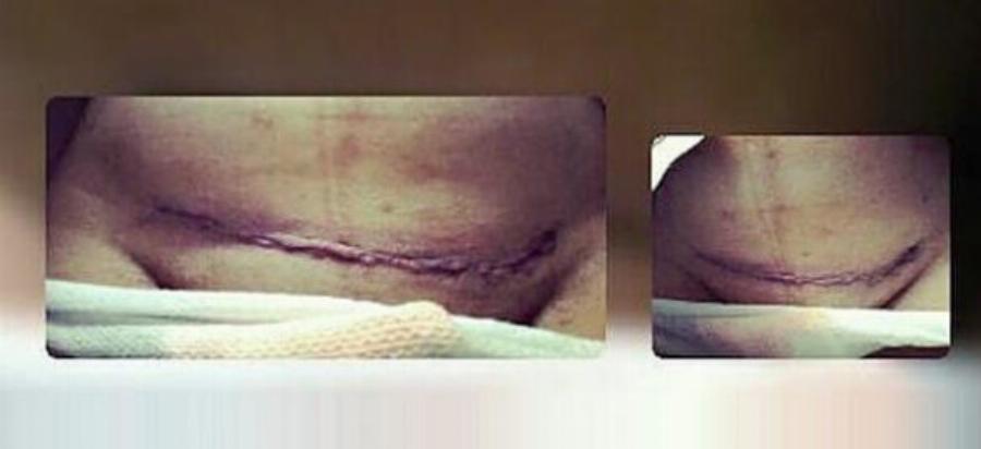 Η αποστομωτική απάντηση μιας μητέρας σε όσους νομίζουν ότι η καισαρική είναι «ο εύκολος τρόπος»