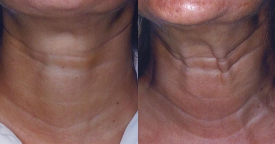 8 λύσεις για να αντιμετωπίσετε με φυσικό τρόπο την χαλάρωση στον λαιμό και να δείχνετε νεότερες