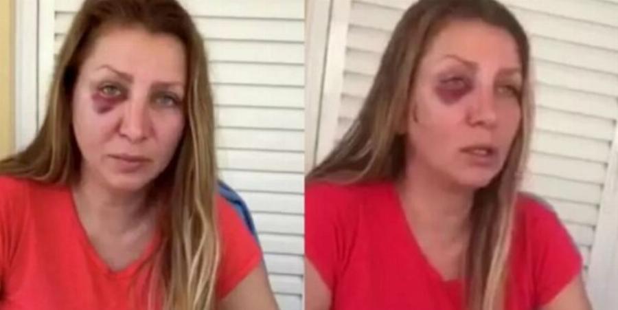 «Φοβόμαστε να μιλήσουμε ρώσικα στον δρόμο» δηλώνει στην κάμερα η Οξάνα που ξυλοκοπήθηκε από Ουκρανούς στην Αθήνα