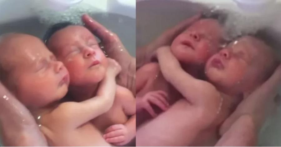 Δίδυμα μωράκια δεν έχουν καταλάβει ότι γεννήθηκαν και παραμένουν αγκαλιασμένα όπως ήταν μέσα στην κοιλιά της μαμάς τους