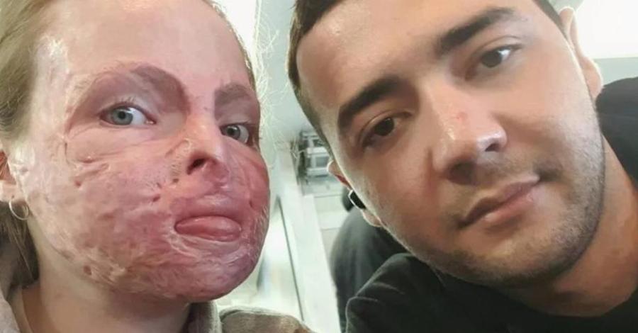 Ιρλανδία: Μαθήματα ζωής δίνει 24χρονη που υπέστη βαριά εγκαύματα εξαιτίας πυρκαγιάς