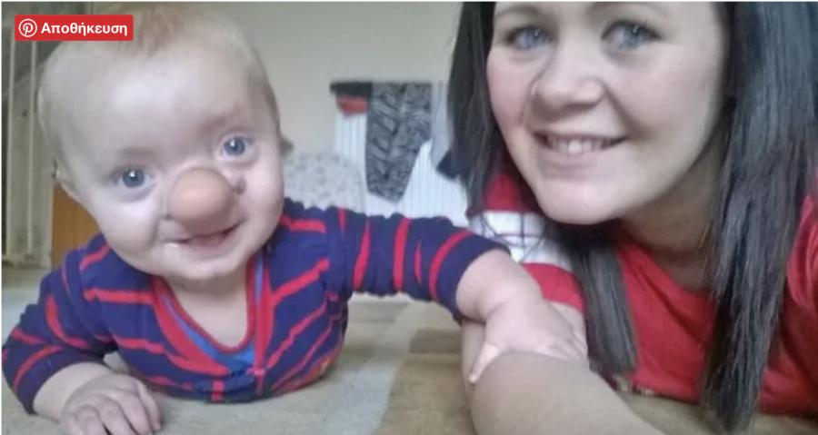 «Πινόκιο της πραγματικής ζωής»: Η σπάνια πάθηση του παιδιού, που ο εγκέφαλός του μεγαλώνει στη μύτη του