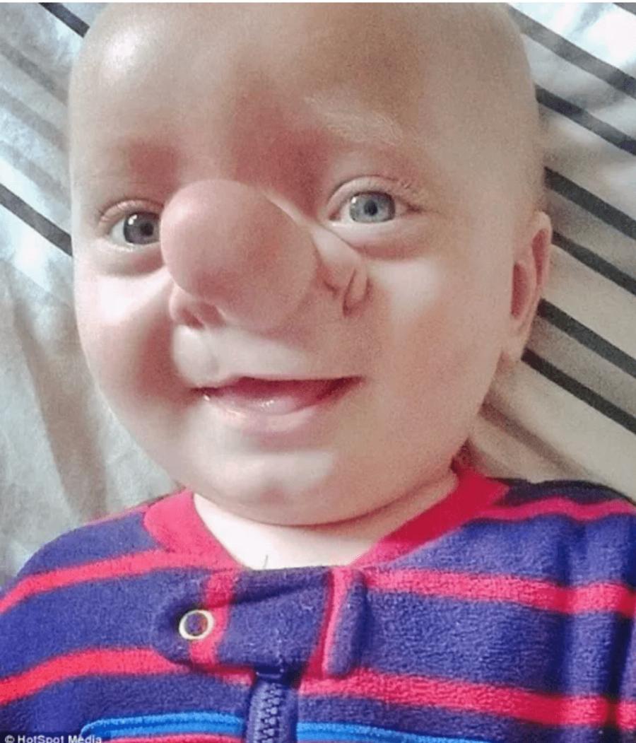 «Πινόκιο της πραγματικής ζωής»: Η σπάνια πάθηση του παιδιού, που ο εγκέφαλός του μεγαλώνει στη μύτη του