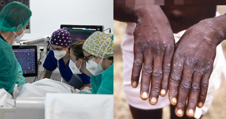 Αυτή είναι η ομάδα που κινδυνεύει πιο πολύ να κολλήσει από την Ευλογιά των πιθήκων στην Ελλάδα