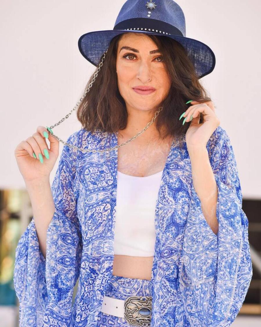 Δύναμη ψυχής από την Ιωάννα Παλιοσπύρου: Φωτογραφίζεται σε καλοκαιρινό mood και μάς δείχνει τα σημάδια στο σώμα της