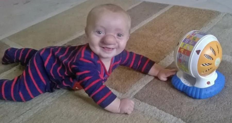 «Πινόκιο της πραγματικής ζωής»: Η σπάνια πάθηση του παιδιού, που ο εγκέφαλός του μεγαλώνει στη μύτη του