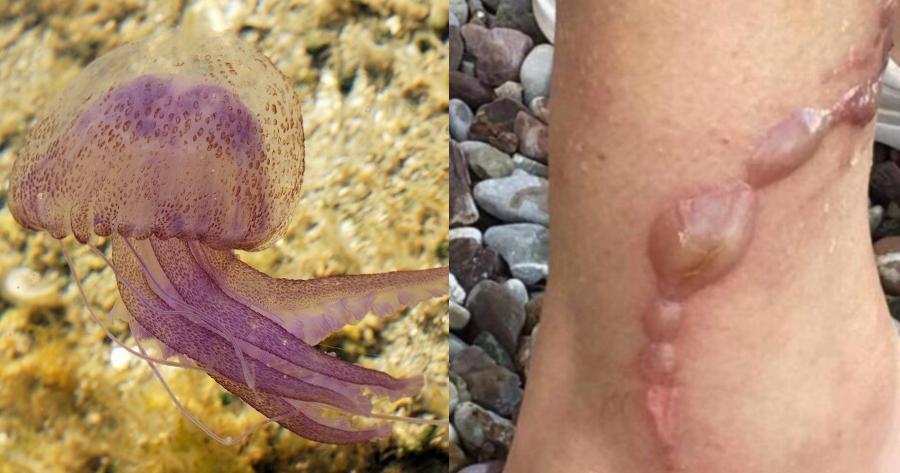 Αν σε τσιμπήσει Μωβ Μέδουσα γεμίζεις φουσκάλες που κρατάνε μέχρι και 6 μήνες – Οι πιο επικίνδυνες παραλίες