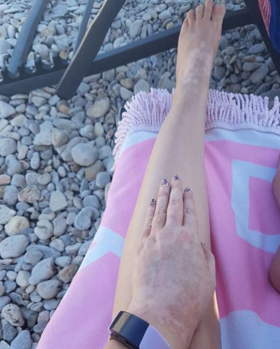 Άνζτελα Δημητρίου: Η κόρη της, Όλγα Κιουρτσάκη, η διάγνωση πριν από 13 χρόνια, το αυτοάνοσο που την ταλαιπωρεί και τα σημάδια στο σώμα της