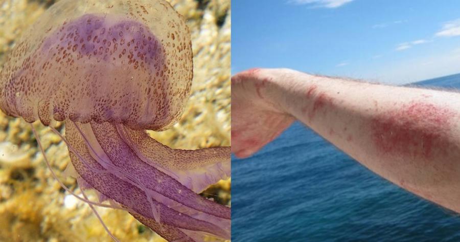 Μωβ Μέδουσα: Τα συμπτώματα, τι να κάνετε αν σας τσιμπήσει, πότε να πάτε σε γιατρό και τι να αποφύγετε να ρίξετε πάνω