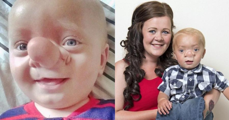 «Πινόκιο της πραγματικής ζωής»: Η σπάνια πάθηση του παιδιού, που ο εγκέφαλός του μεγαλώνει στη μύτη του