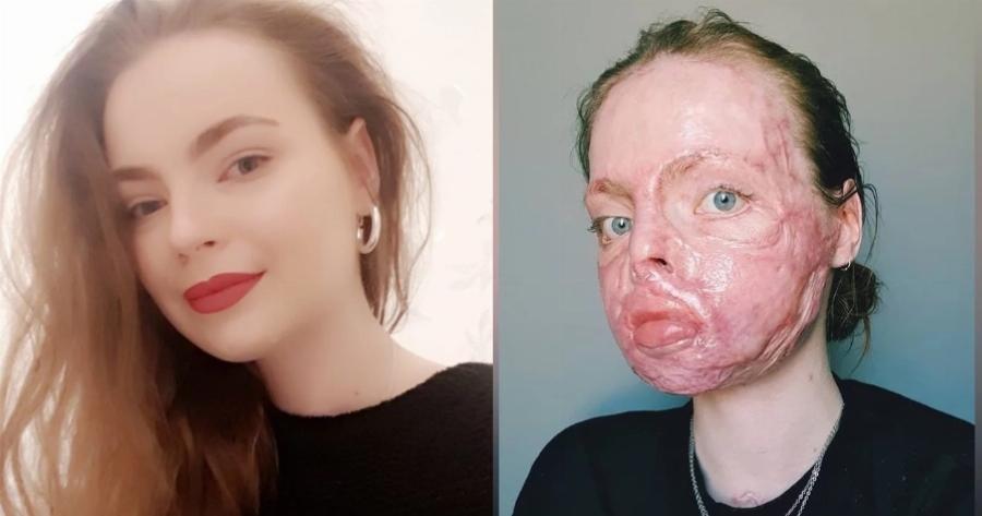 Ιρλανδία: Μαθήματα ζωής δίνει 24χρονη που υπέστη βαριά εγκαύματα εξαιτίας πυρκαγιάς