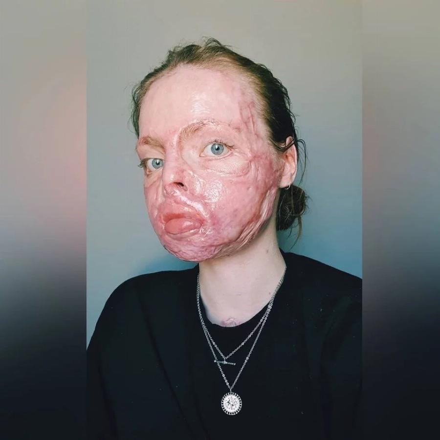 Ιρλανδία: Μαθήματα ζωής δίνει 24χρονη που υπέστη βαριά εγκαύματα εξαιτίας πυρκαγιάς