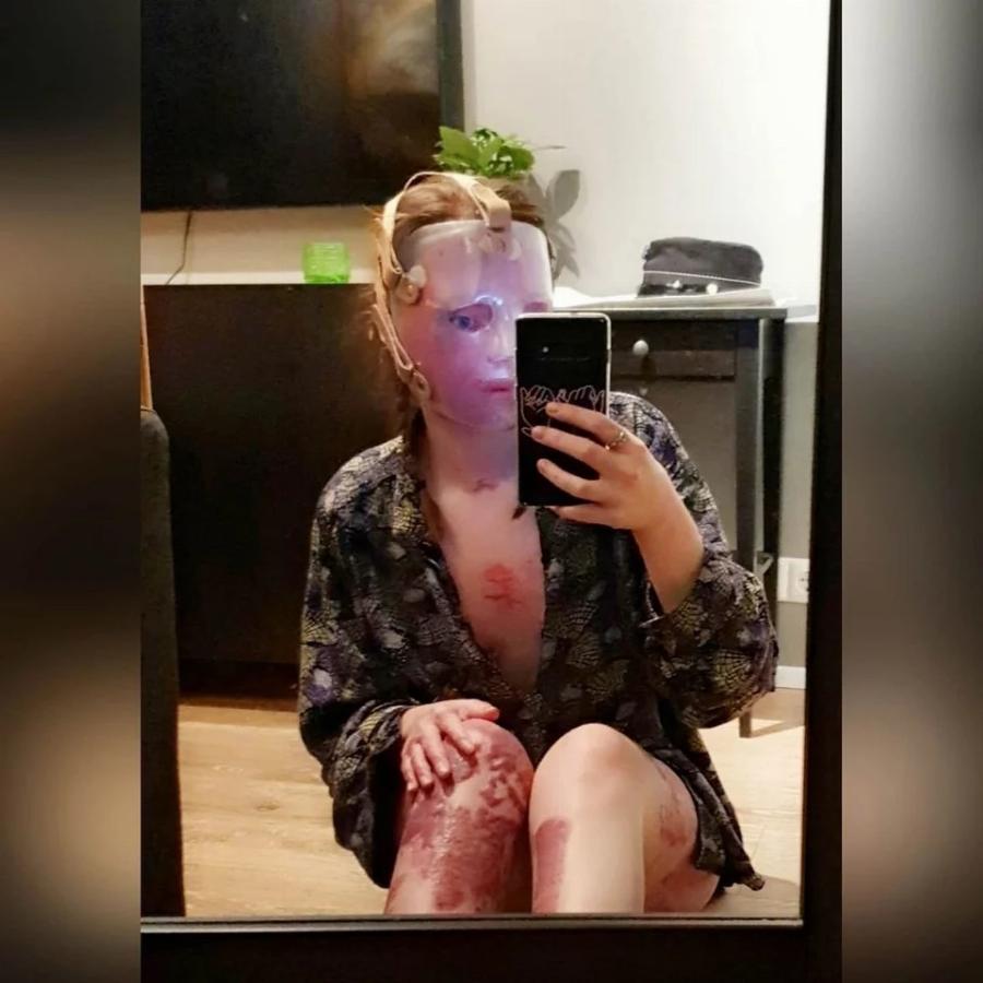 Ιρλανδία: Μαθήματα ζωής δίνει 24χρονη που υπέστη βαριά εγκαύματα εξαιτίας πυρκαγιάς