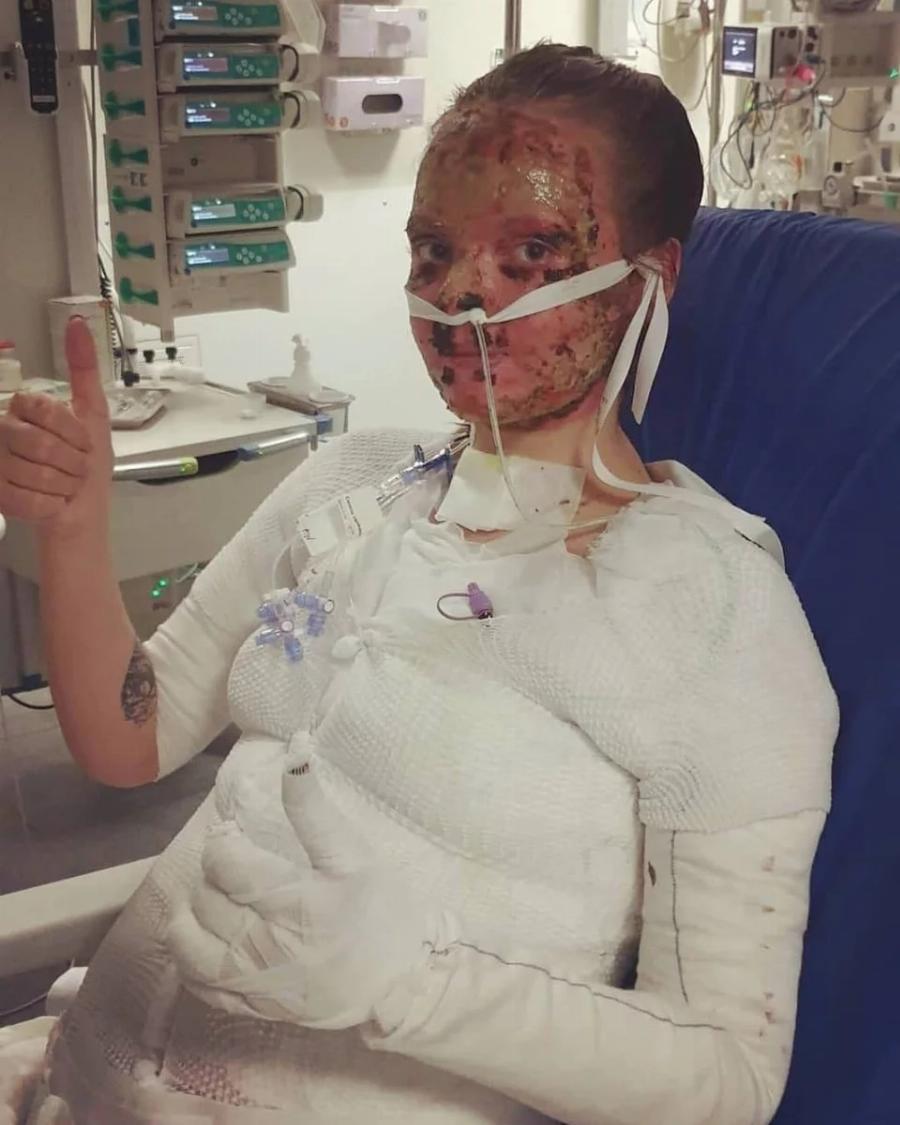 Ιρλανδία: Μαθήματα ζωής δίνει 24χρονη που υπέστη βαριά εγκαύματα εξαιτίας πυρκαγιάς