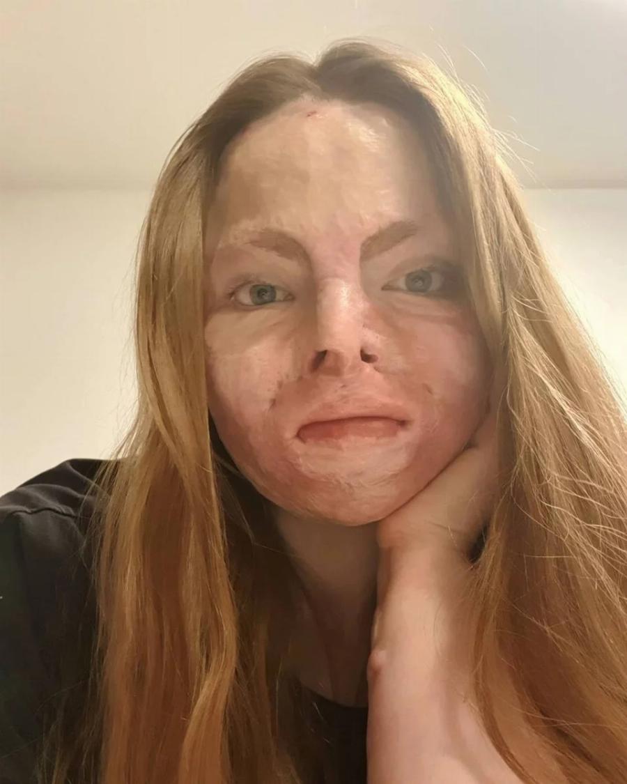 Ιρλανδία: Μαθήματα ζωής δίνει 24χρονη που υπέστη βαριά εγκαύματα εξαιτίας πυρκαγιάς