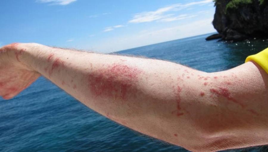 Μωβ Μέδουσα: Τα συμπτώματα, τι να κάνετε αν σας τσιμπήσει, πότε να πάτε σε γιατρό και τι να αποφύγετε να ρίξετε πάνω