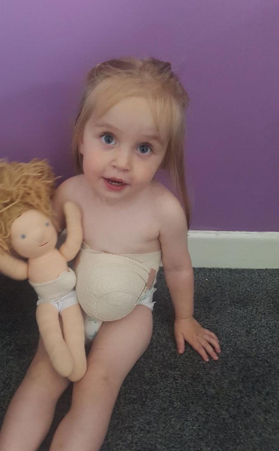 Δίχρονο κοριτσάκι ζει με το στομάχι έξω από το σώμα του, εξαιτίας μιας σπάνιας πάθησης