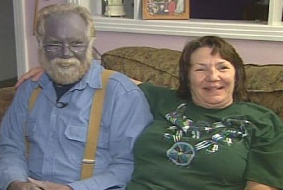 «Μπλε Φουγκέιτ»: Το σπάνιο μπλε δέρμα της οικογένειας – Το ιατρικό μυστήριο, η απομόνωση και ο τελευταίος επιζών