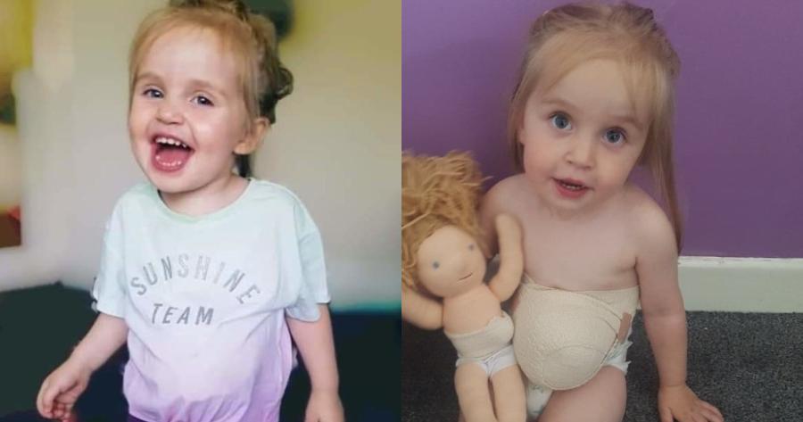 Δίχρονο κοριτσάκι ζει με το στομάχι έξω από το σώμα του, εξαιτίας μιας σπάνιας πάθησης