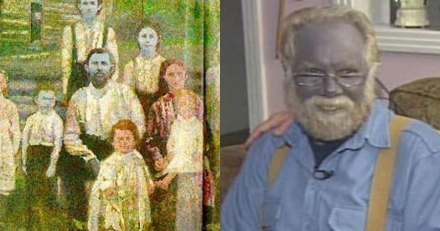 «Μπλε Φουγκέιτ»: Το σπάνιο μπλε δέρμα της οικογένειας – Το ιατρικό μυστήριο, η απομόνωση και ο τελευταίος επιζών