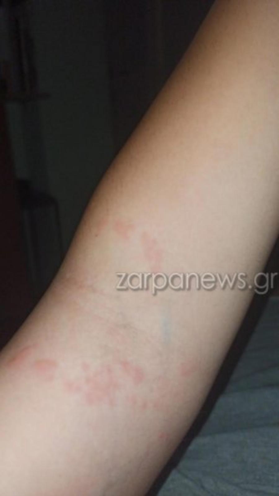 Χανιά: Διπλό τσίμπημα από μωβ μέδουσες σε τουρίστρια – Εμφάνισε πόνο, ζαλάδα και ταχυπαλμία