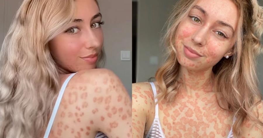 25χρονη αναδεικνύει την ιδιαιτερότητα της: Έχει ψωρίαση και δεν φοβάται πια να φορέσει μπικίνι