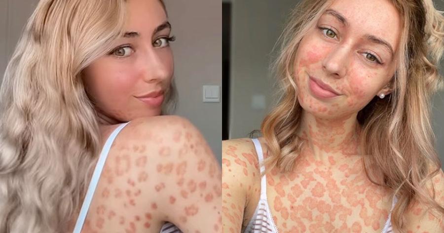 25χρονη αναδεικνύει την ιδιαιτερότητα της: Έχει ψωρίαση και δεν φοβάται πια να φορέσει μπικίνι