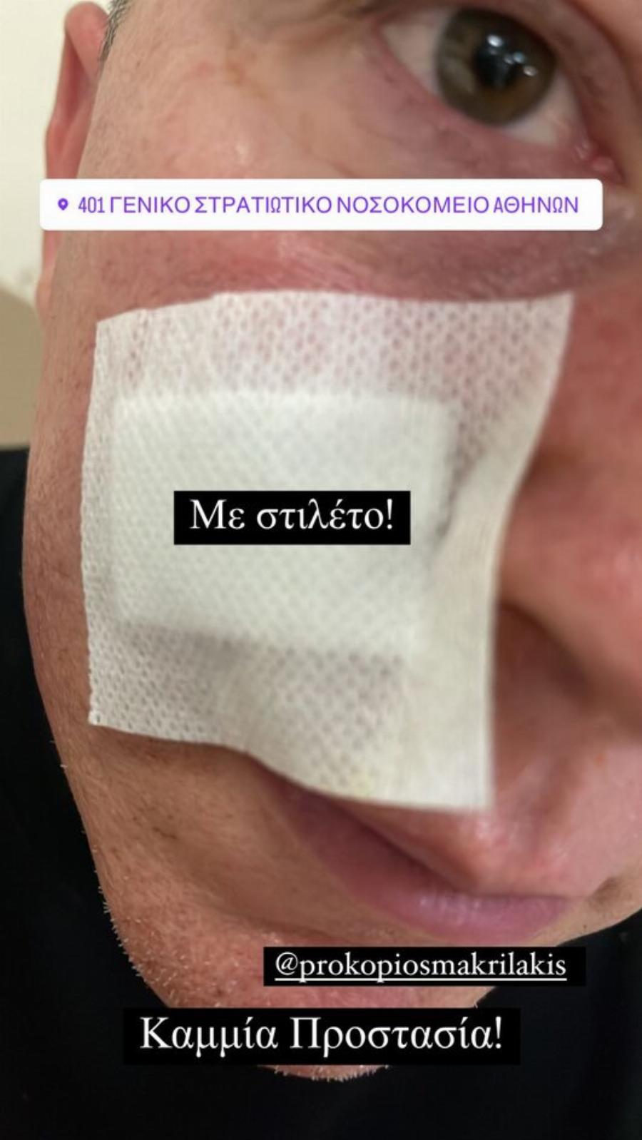 Του επιτέθηκαν στη πλατεία Συντάγματος: Ο Βασίλειος Κωστέτσος θύμα άγριας επίθεσης από αλλοδαπούς στην Αθήνα