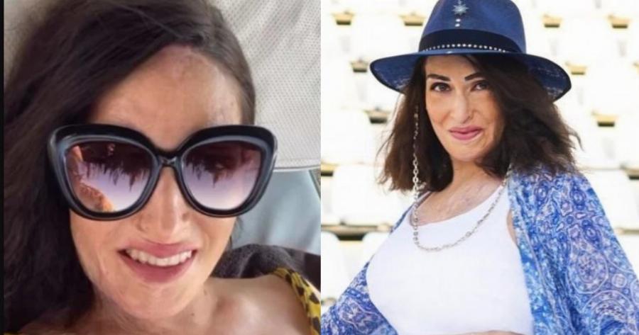 Είναι πανέμορφη: Η Ιωάννα Παλιοσπύρου με μπικίνι δείχνει τις ούλες της και περνάει δυνατό μήνυμα