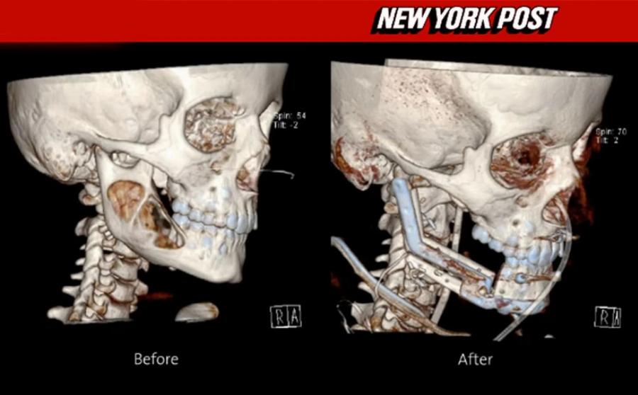 Συγκλονιστική ιστορία: Αφαίρεσαν όγκο σε μέγεθος αυγού από το στόμα του 9χρονου Δημήτρη – Αντικατέστησαν σπασμένα μέρη με κόκαλο από το πόδι του