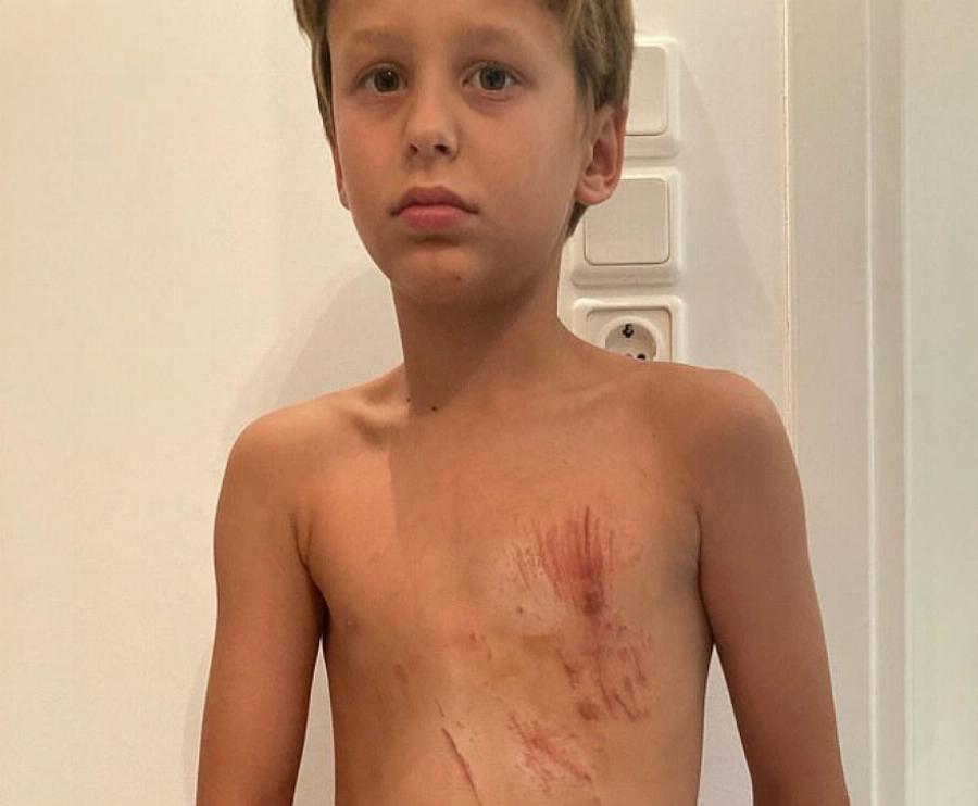 «Πάλεψα για να σώσω τα παιδιά μου»: 100 ράμματα στον 50χρονο που δέχθηκε επίθεση από αγέλη σκύλων